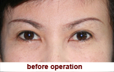 plastic-surgery-blepharoplasty